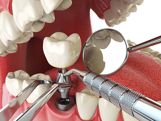 Best Lost Filling or Crown Replacement in Flora, AL